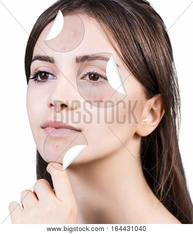 Circles layers of skin with acne unstick from good healthy skin of young woman.