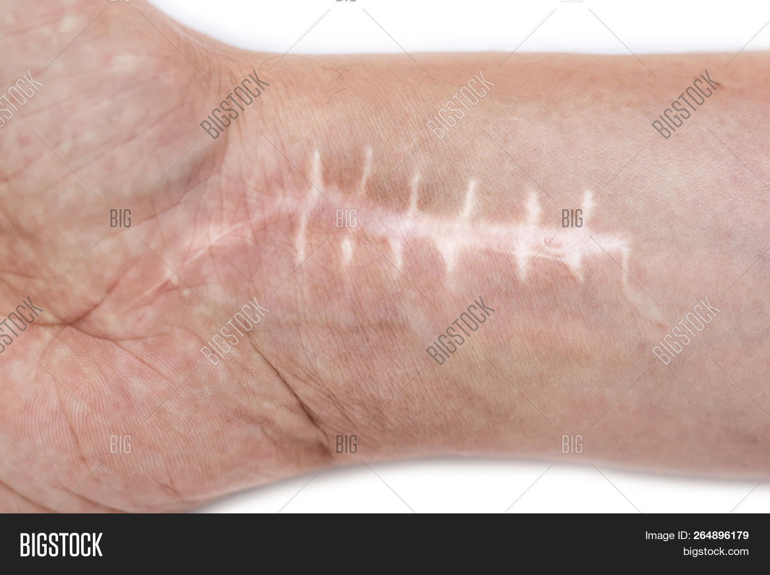 Scar Stitches On Wrist Image & Photo (Free Trial) Bigstock