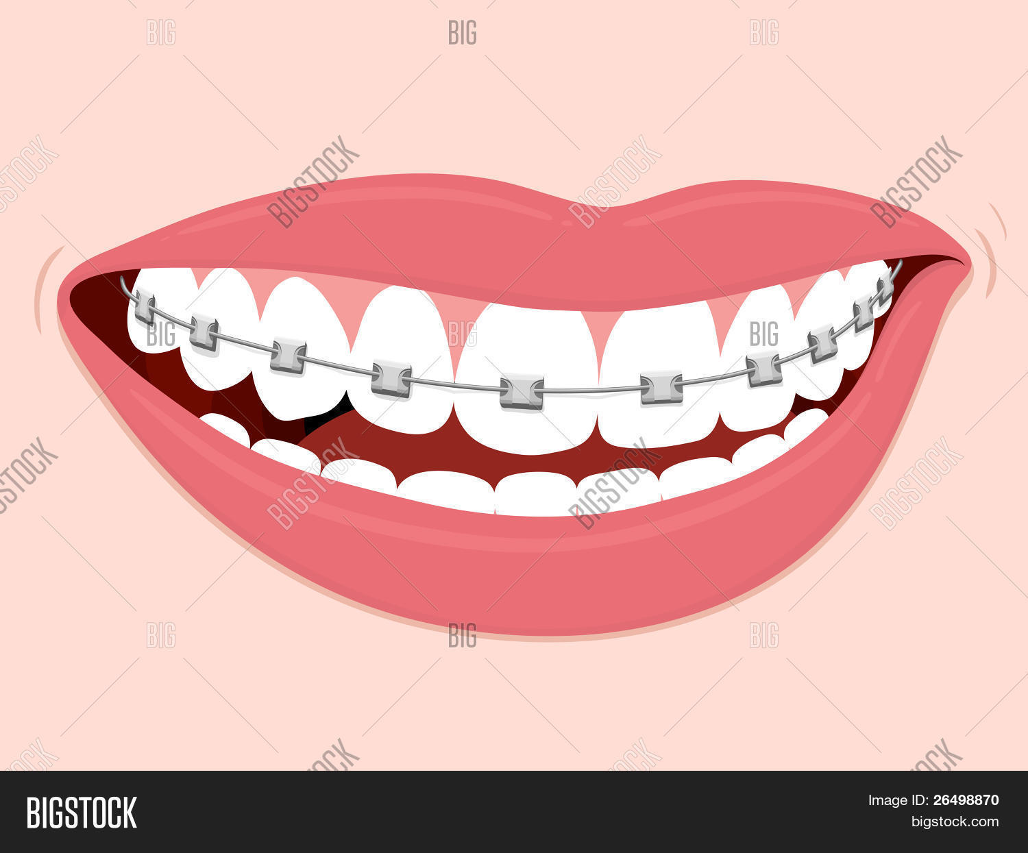 Braces Corrective Vector & Photo (Free Trial) Bigstock