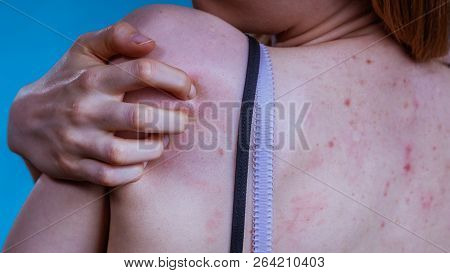 Health Problem, Skin Diseases. Young Woman Showing Her Back With Acne, Red Spots. Teen Girl Scratchi