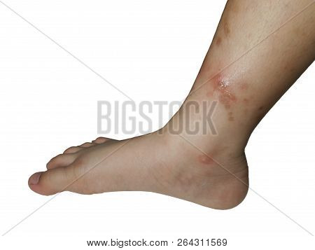 The Legs Of Children Whom Have The Blisters From Scratched On White Background.