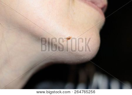 Mole On The Face On The Chin With Hair Growing Out Of It