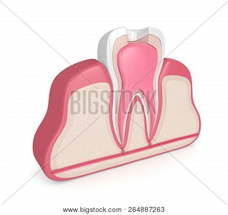 3D Render Of Tooth With Root Canal Treatment Procedure