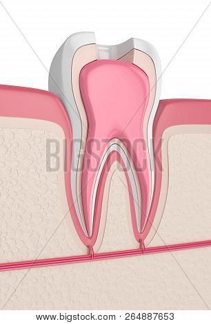 3D Render Of Tooth With Root Canal Treatment Procedure