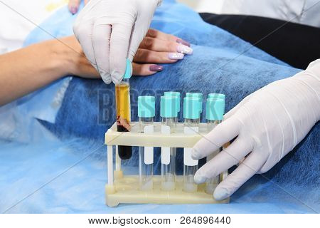 Plasmolifting hands. Injections for rejuvenation and skin regurgitation from human plasma. A modern