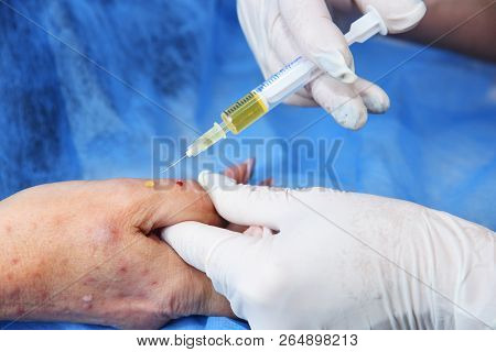 Plasmolifting Hands. Injections For Rejuvenation And Skin Regurgitation From Human Plasma. A Modern 