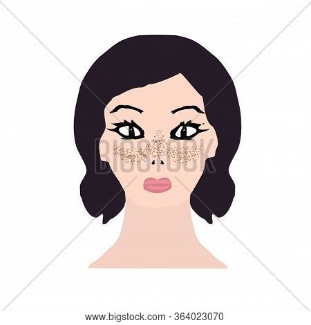 Freckles On The Face. Pigmentation On The Skin. A Pigmented Spot On The Skin Of The Face. Before And