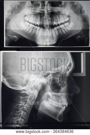 Odontostomalogical Radiographs, Digital Orthopantomography For Dental Diagnosis