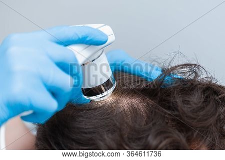 Trichoscopy Of Hair And Scalp Closeup. Trichoscope In The Hands Of A Doctor