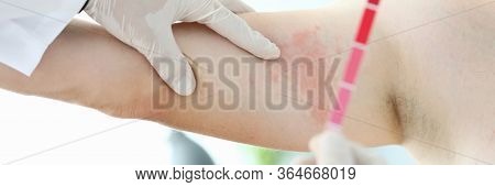 Male Doctor Hold Allergy Express Test In Hand Closeup. Choosing Skin Treatment Method Concept