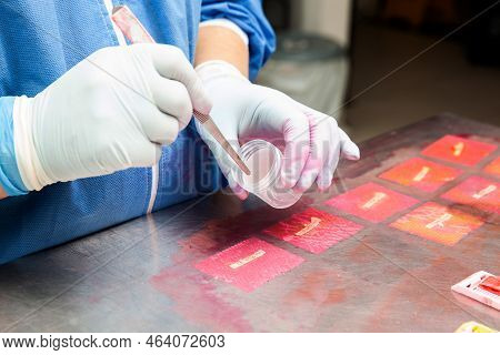 Biopsy Samples Being Processed At The Pathology Laboratory To Be Embedded In Paraffin For Analysis.