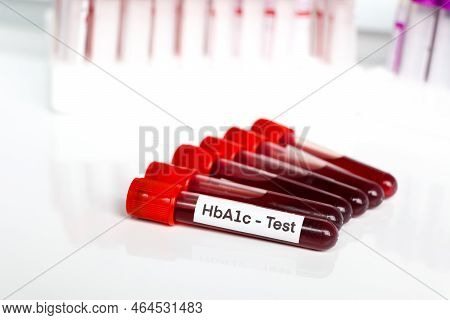 Hba1c Test From Blood , Blood Samples To Be Analyzed In The Laboratory, Red Blood In Test Tube