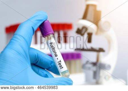 Urine Samples For Testing Ketones In The Laboratory, Urine Sample In Test Tube