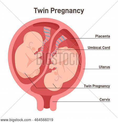Twin Pregnancy. Anatomy Of Womb With Twin Fetuses. Dizygotic