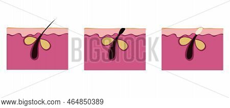 The Skin Is Healthy And With Acne. Flat Style. Vector Illustration Isolated On White Background.