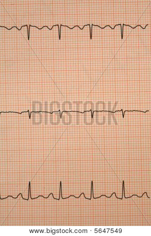 ELECTROCARDIOGRAMA