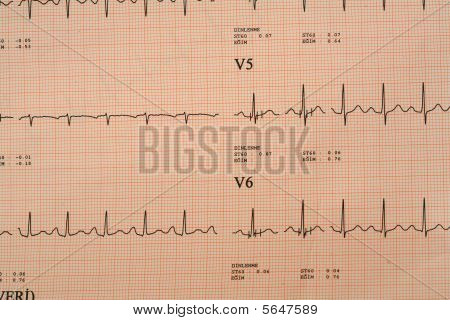 ELECTROCARDIOGRAMA