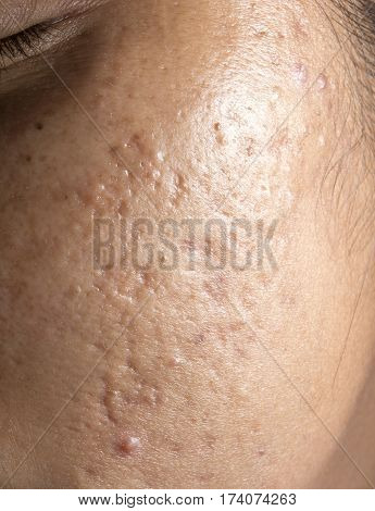 Women with closeup problematic skin and acne scars