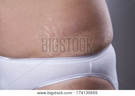 Woman's belly with stretch marks closeup on gray background
