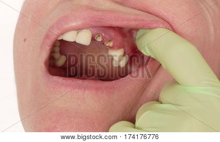 Dental Care, Broken Teeth
