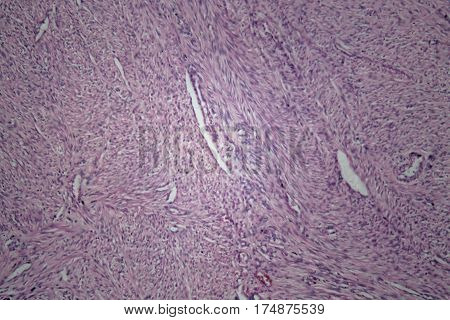 Cells of human uterus tissue with inoffensive tumor cells under a microscope.