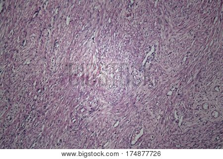 Cells of human uterus tissue with inoffensive tumor cells under a microscope.