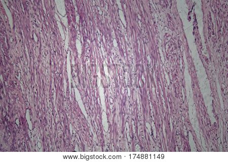 Cells of human uterus tissue with inoffensive tumor cells under a microscope.