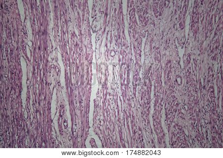 Cells of human uterus tissue with inoffensive tumor cells under a microscope.