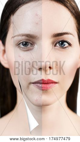 Layer with bad skin unstick from good healthy skin.