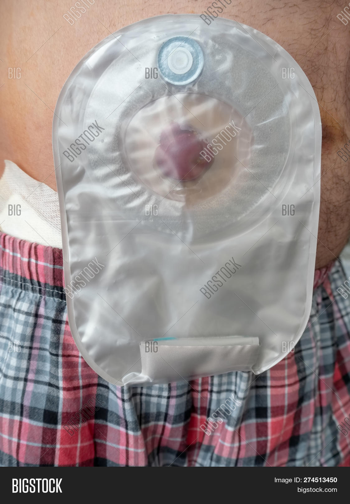 Ileostomy Attached Image & Photo (Free Trial) Bigstock