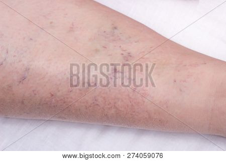 Vascular Marks On The Skin From Varicose Veins, Vascular Pattern On The Skin, Close-up, Phlebeurysm,