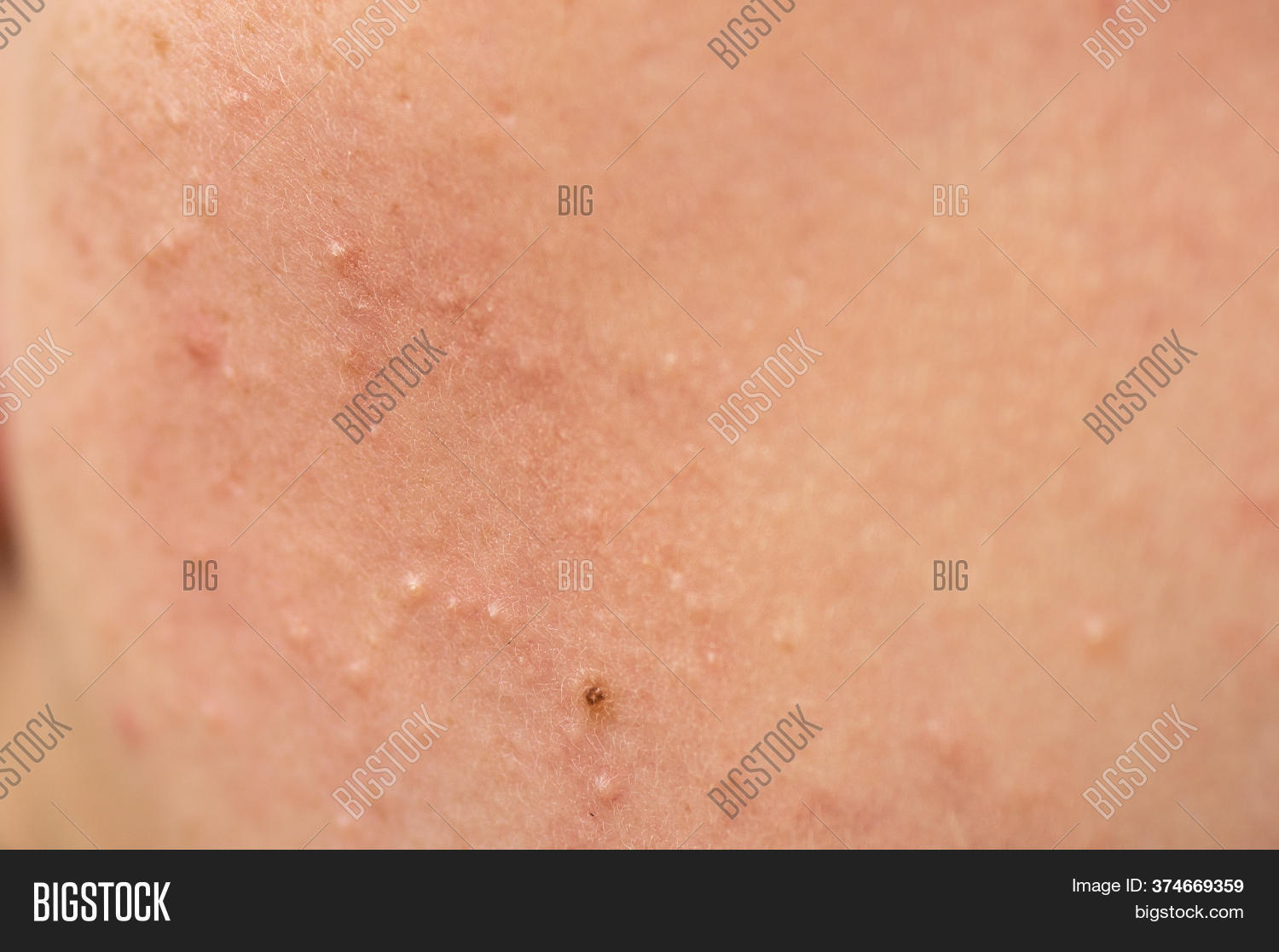Problematic Skin. Acne Image & Photo (Free Trial) | Bigstock