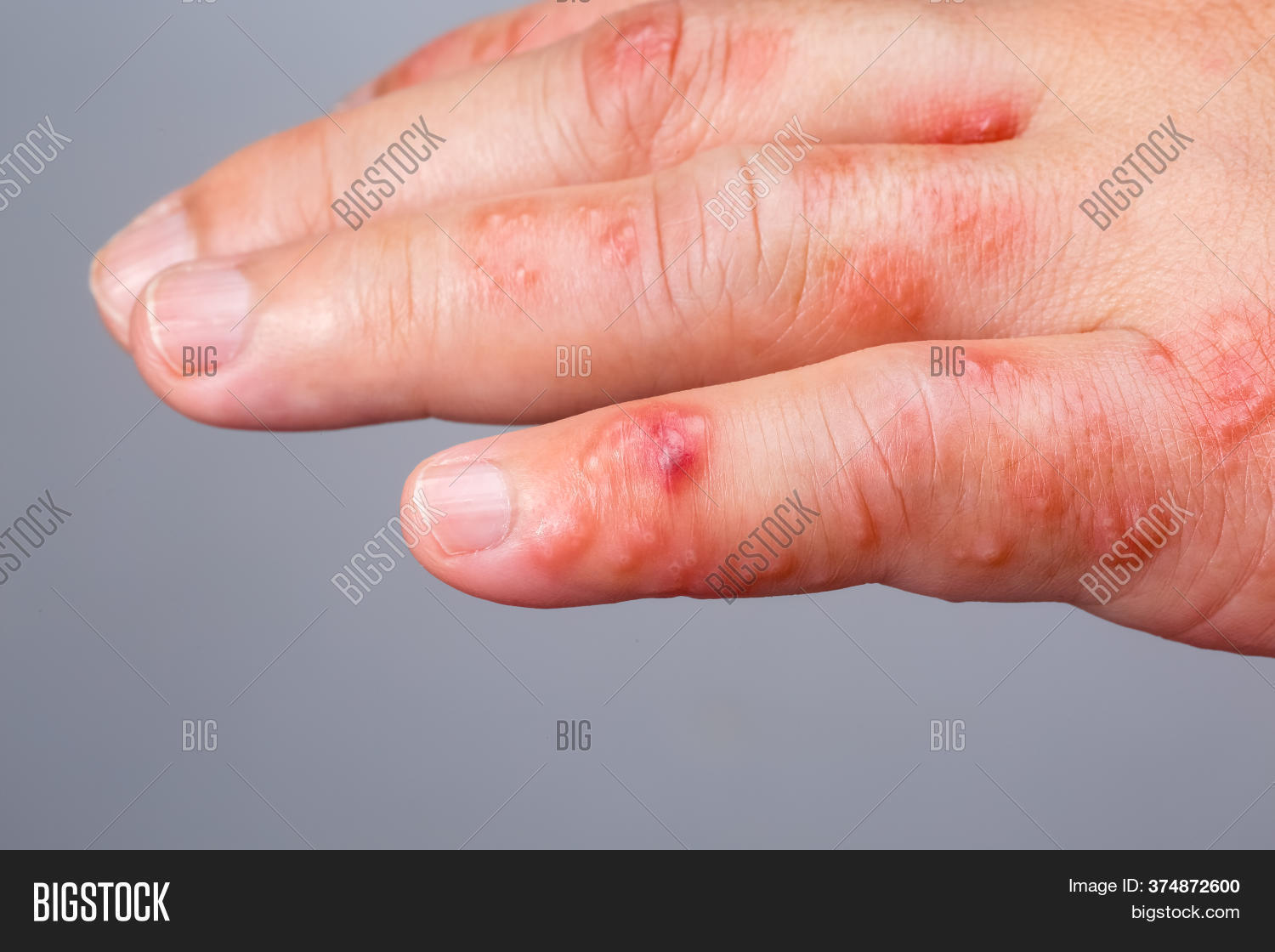 Shingles, Zoster Image & Photo (Free Trial) Bigstock