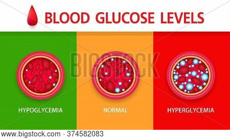 Hyperglycemia, High Blood Sugar And Diabetes ,obesity Is A Serious Medical Condition Causes, Vector 