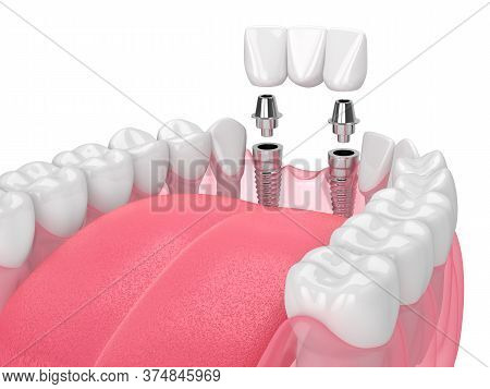 Jaw With Implants Supporting Dental Bridge Over White Background