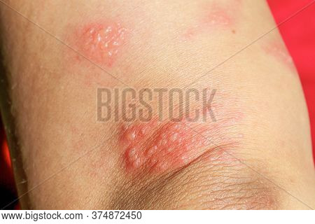 Skin Rash As Allergic Symptoms Due To Arm Fiberglass Cast