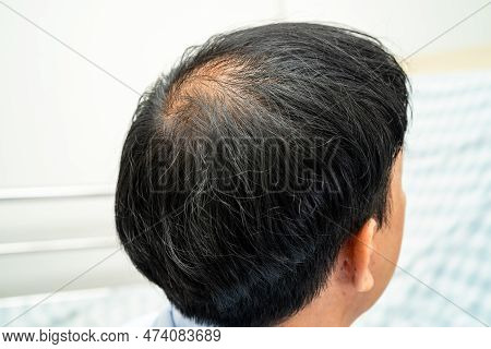 Bald At Front Of Head And Begin No Loss Hair Glabrous Of Mature Asian Business Smart Active Office M