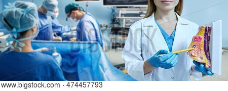 Breast Cancer Surgery, Conceptual Image. Surgeons Remove Malignant Breast Tumor Of Female Patient Ly