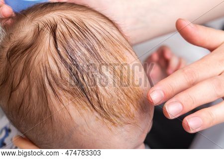 Smearing A Seborrheic Crust With Baby Oil On A Child's Head. Combing And Removal Of Seborrheic Crust