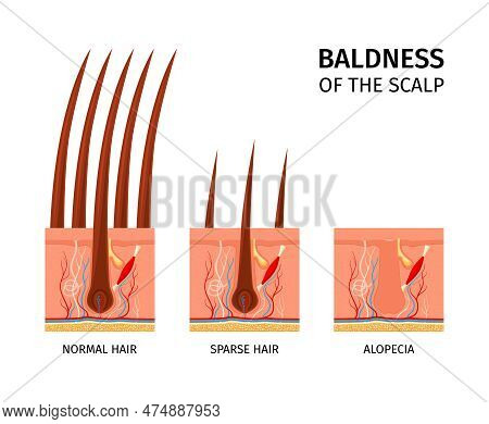 Realistic Hair Structure Composition With Text Captions And Isolated Views Of Normal Sparse Hair And