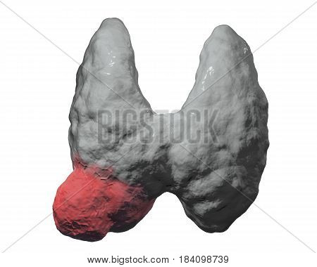Thyroid cancer. 3D illustration showing thyroid gland with tumor isolated on white background