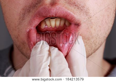 Stomatitis on the lips of a man