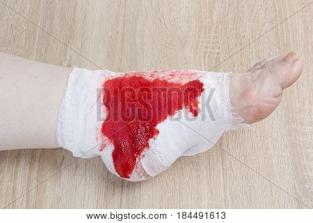 White medicine bandage on human injury foot