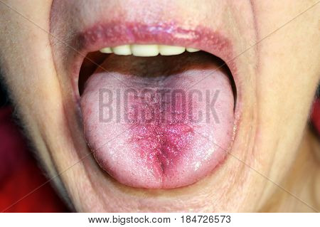 The tongue is in a white raid. Candidiasis. The tongue is red, inflamed. Hyperemia of the mucous membrane