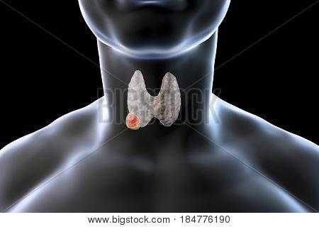 Thyroid cancer. 3D illustration showing thyroid gland with tumor inside human body isolated on black background