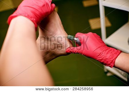 Podology, Treatment Of The Affected Areas Of The Feet, Medical Office, Pedicure