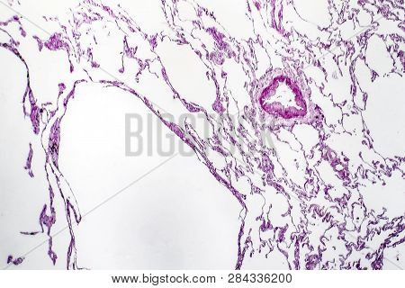 Histopathology Of Lung Emphysema, Light Micrograph, Photo Under Microscope Showing Enlargement Of Ai