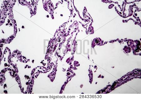 Histopathology Of Lung Emphysema, Light Micrograph, Photo Under Microscope Showing Enlargement Of Ai