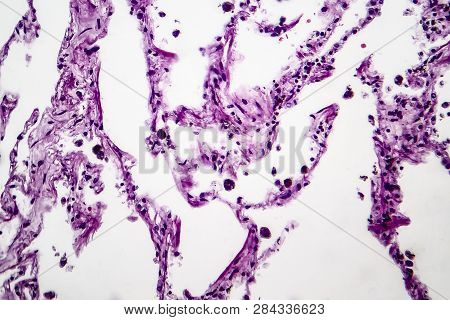 Histopathology Of Lung Emphysema, Light Micrograph, Photo Under Microscope Showing Enlargement Of Ai