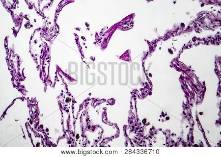 Histopathology Of Lung Emphysema, Light Micrograph, Photo Under Microscope Showing Enlargement Of Ai